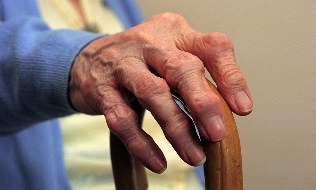 Arthritis and arthrosis of fingers in an elderly person. 