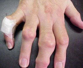 Fingers with joint deformities can cause pain