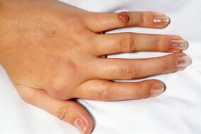 Pain in deformed fingers