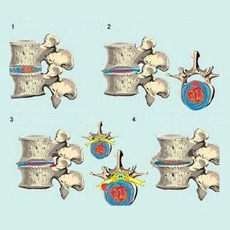 Stages of development of cervical osteochondrosis