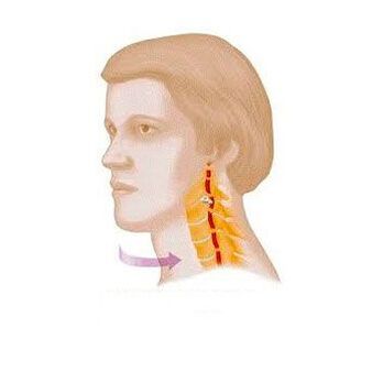 Vertebral body syndrome with cervical osteochondrosis