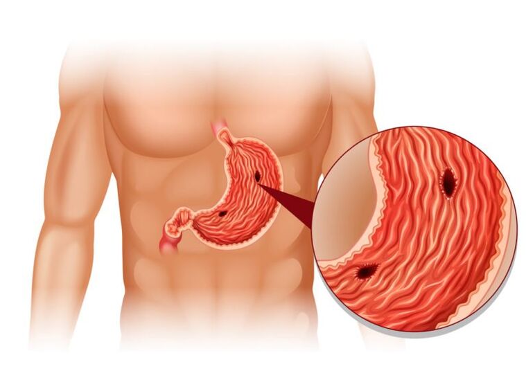 Ulcers are the cause of pain under the left shoulder blade