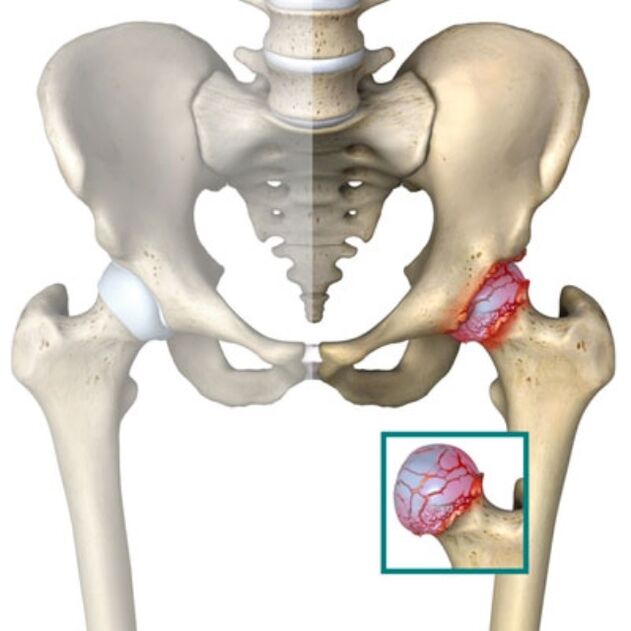 hip joint disease