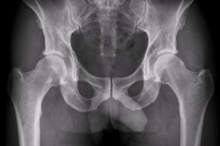 Hip x-ray pain