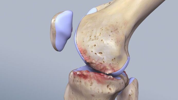 Pathologically affected knee structures