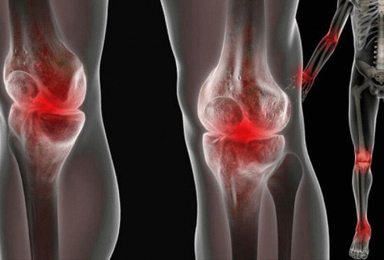 Joint pain in arms and legs caused by various diseases