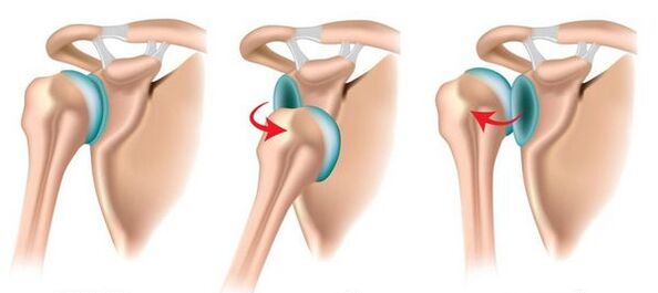 Anterior and posterior dislocation of the shoulder joint, causing arthrosis