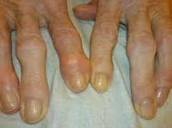 Osteoarthritis of the small joints of the hands