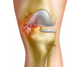 The inflammation of the joints