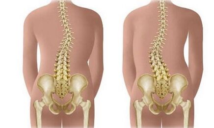 Non-resistant scoliosis