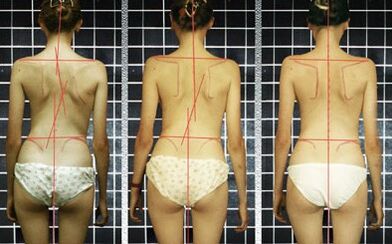 Spinal cord disease