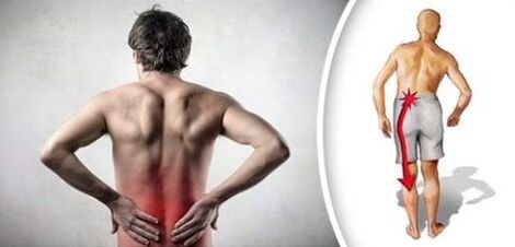 Pain syndrome with lumbar chondrosis radiates to the legs
