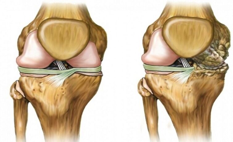 Healthy, affected by joints
