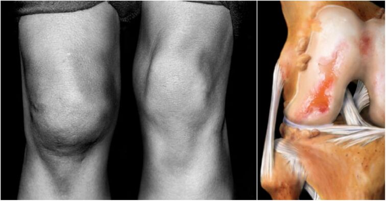 Knee joints and joint aches
