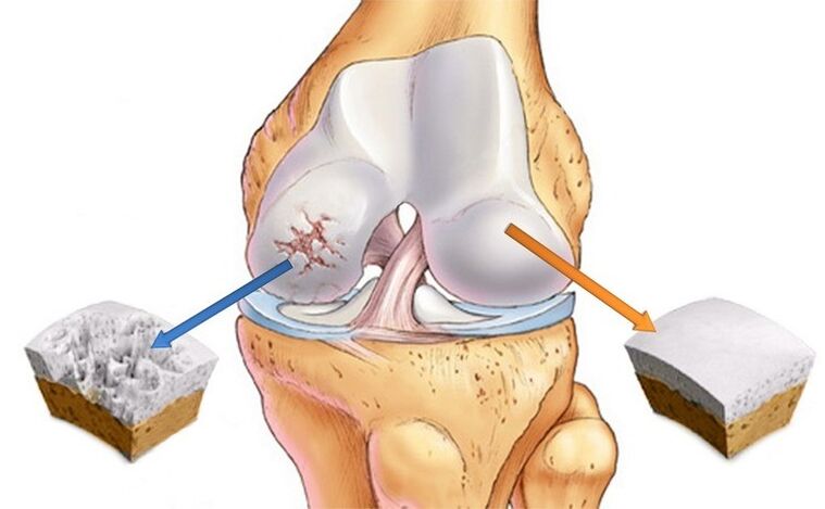 Normal cartilage and affected by joints