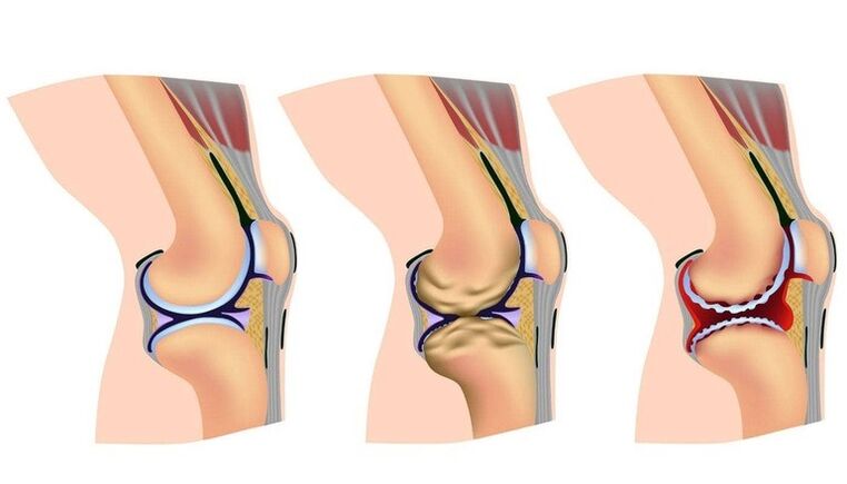 The knee deformation stage of the joint