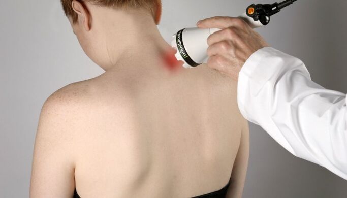 Laser treatment for cervical osteochondrosis