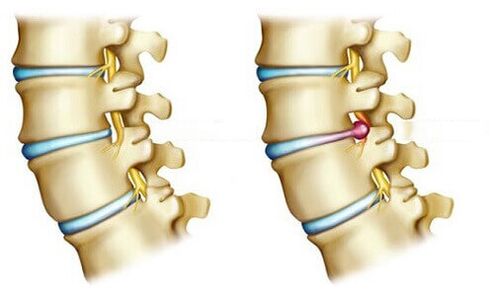 Healthy Discs and Herniated Discs