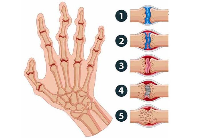Stages of development of arthritis in finger joints
