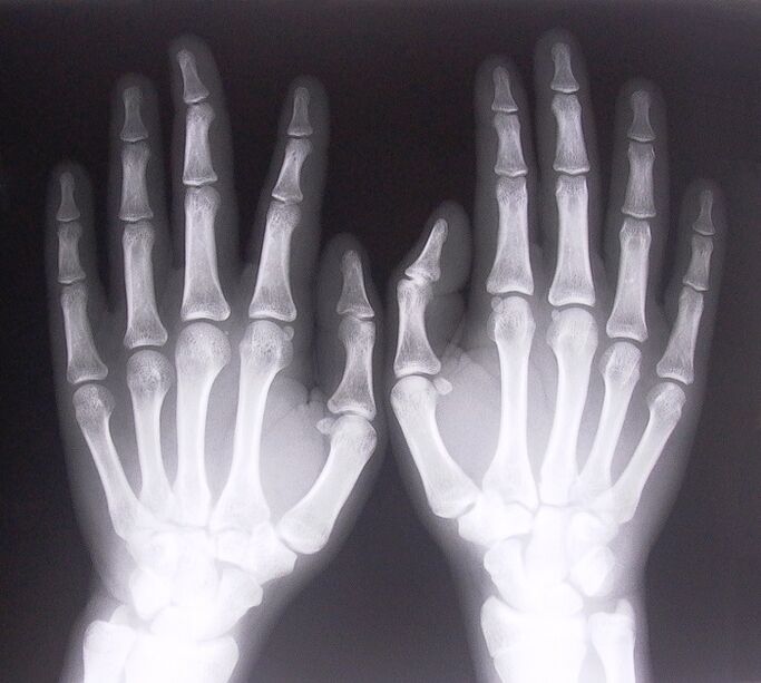 X-rays as a way to diagnose finger joint pain