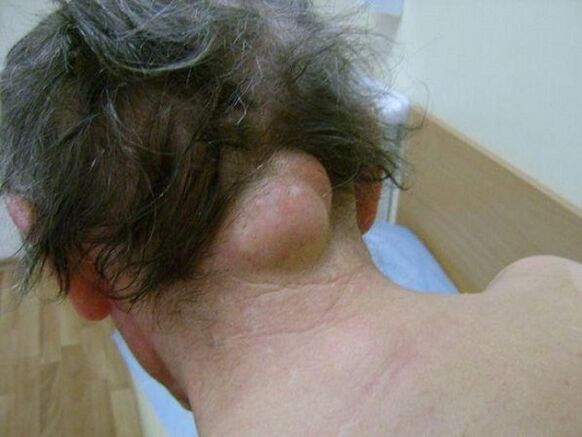 Swelling in the neck causing pain