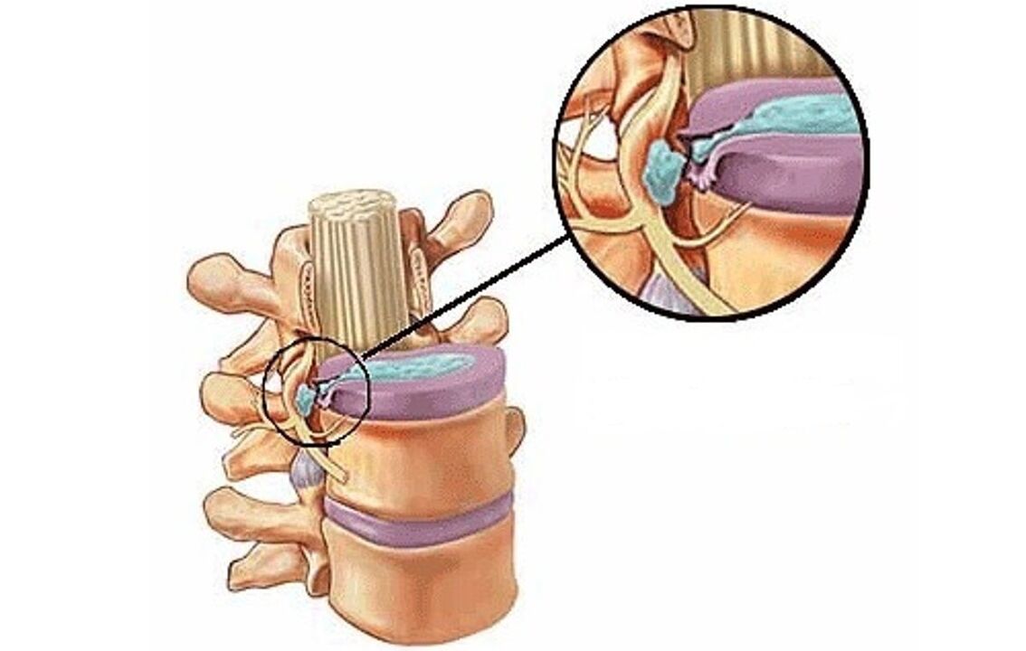 Intervertebral hernia combined with thoracic osteochondrosis