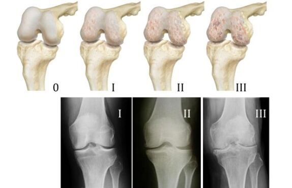 Diagnostic Methods for Knee Arthropathy