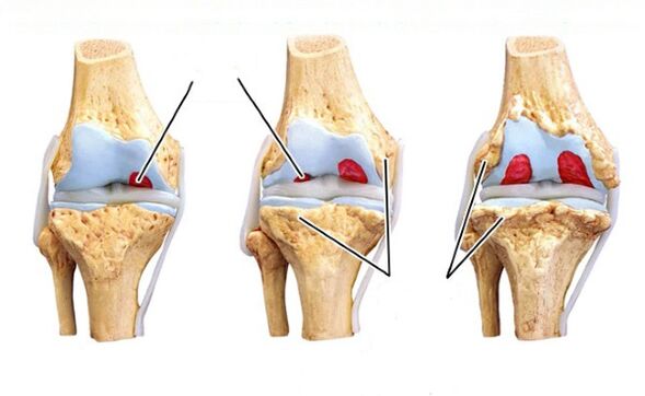 Various stages of knee joint disease