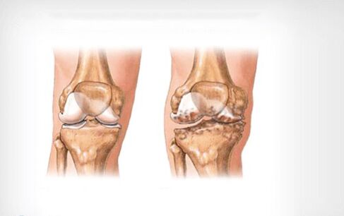 knee arthritis