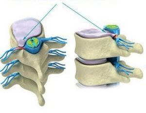 the formation of hernia