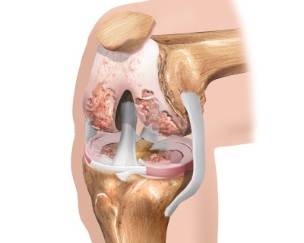 pattern of osteoarthritis